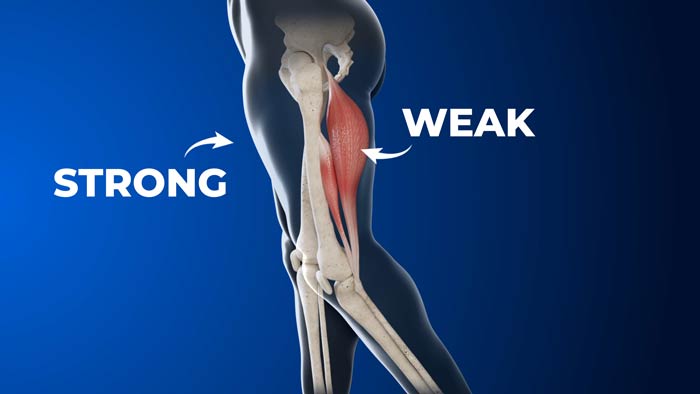 Weak hamstrings vs strong quad muscles